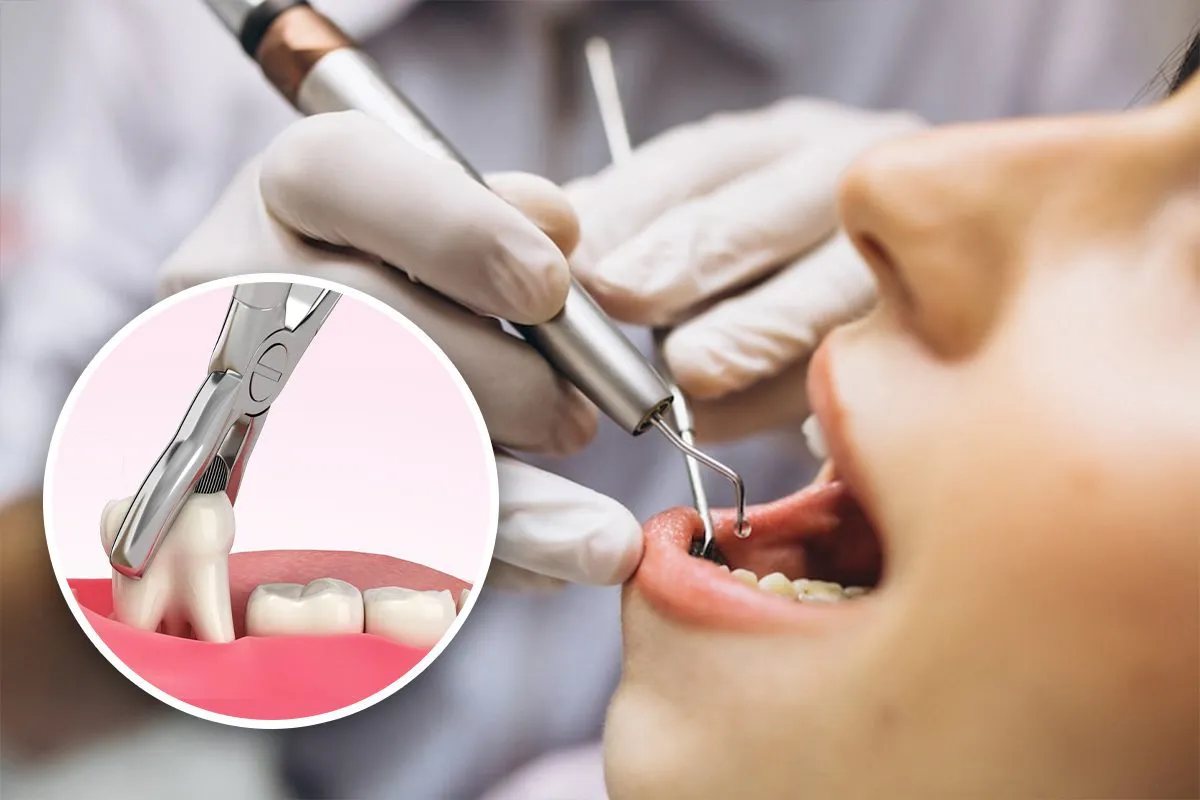 Emergency Tooth Extraction